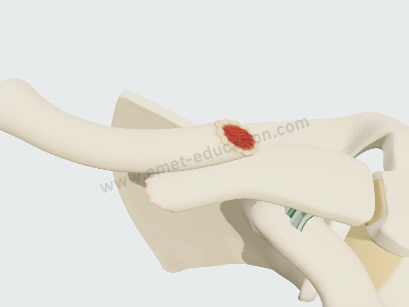 Fracture déplacée et raccourcie : les fragments chevauchent, l'épaule rentre vers le thorax.