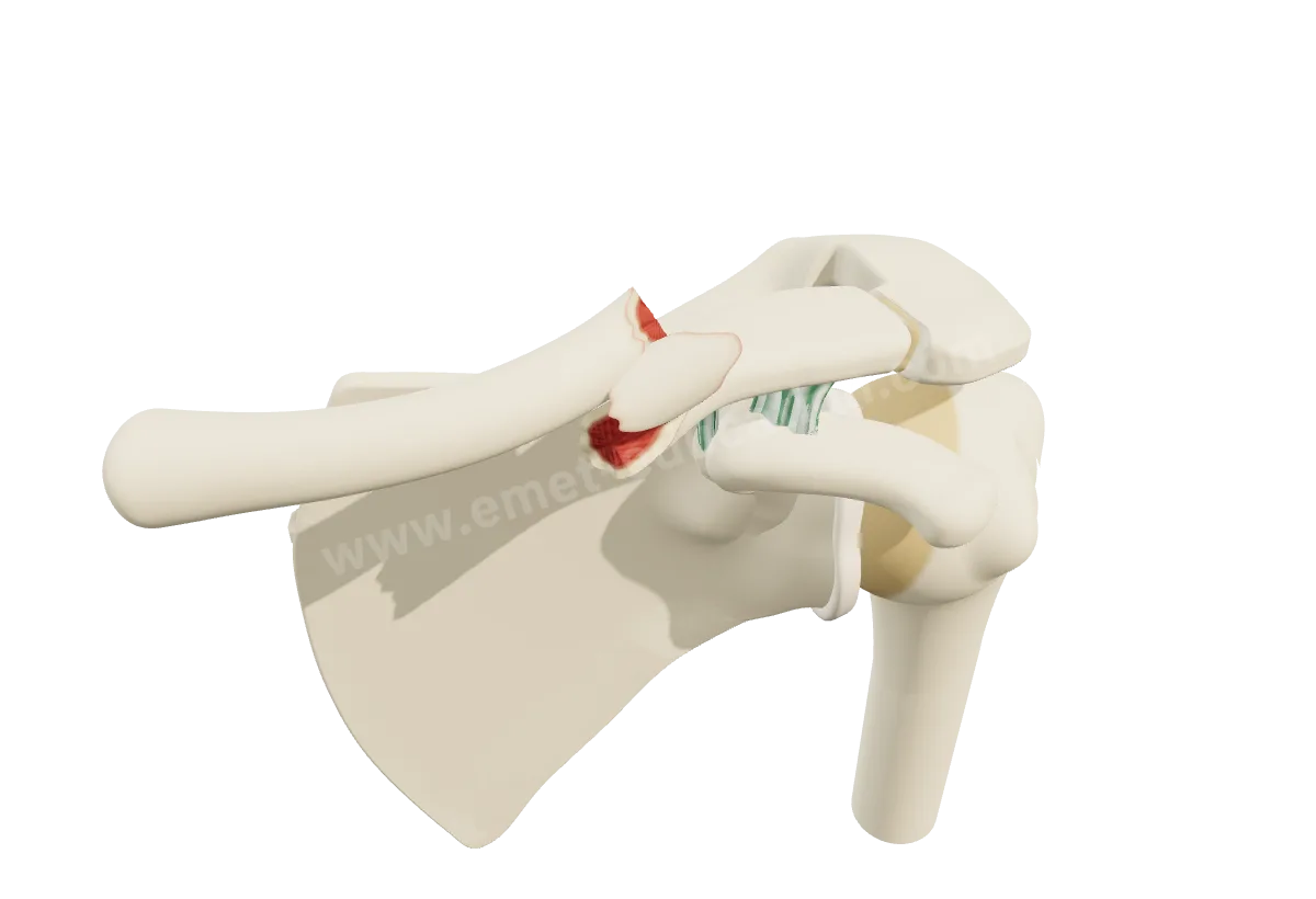 Modèle 3D de l'épaule : fracture déplacée du milieu de la clavicule