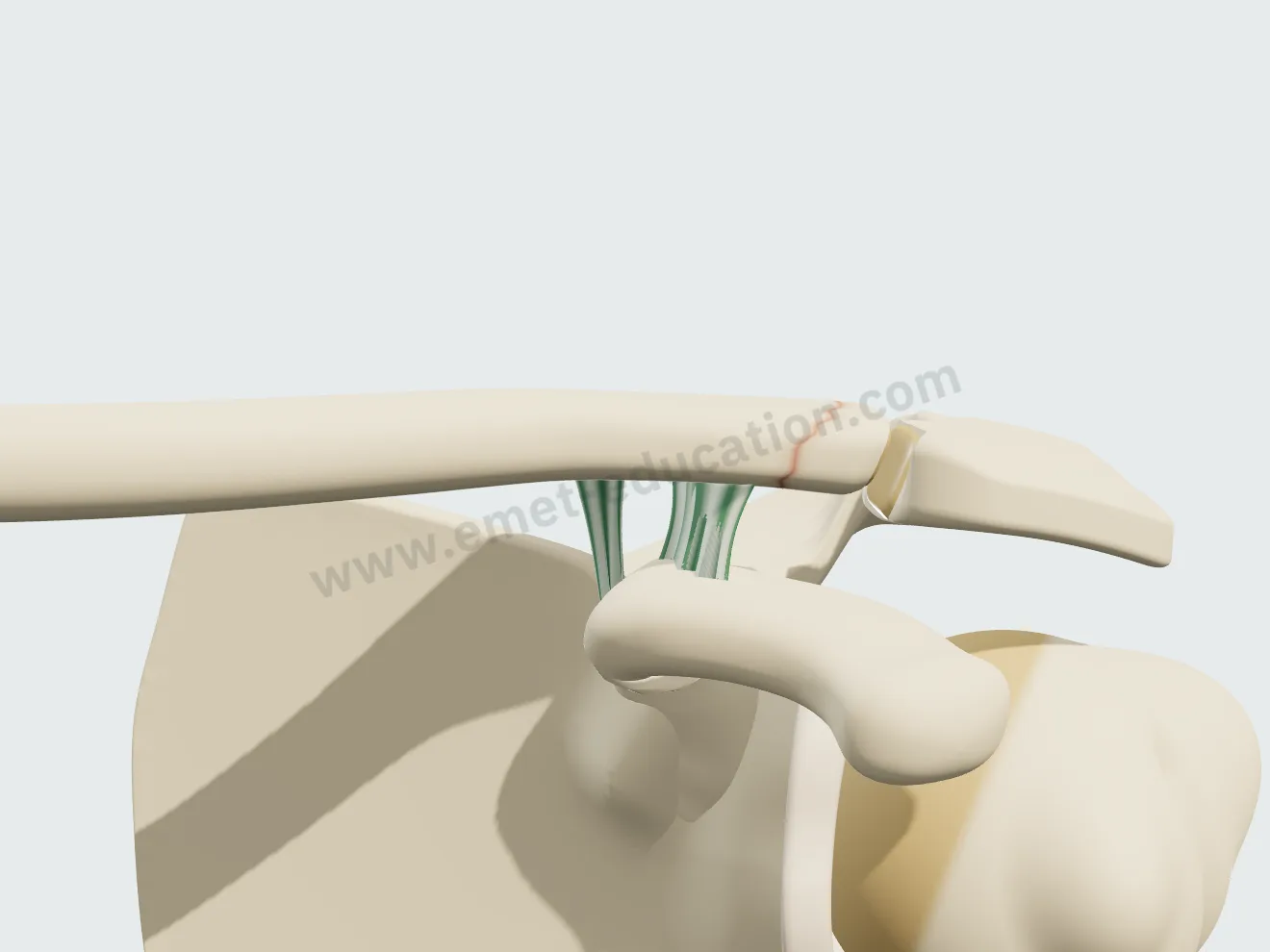 Fracture du bout de la clavicule, en dehors des ligaments : stable.