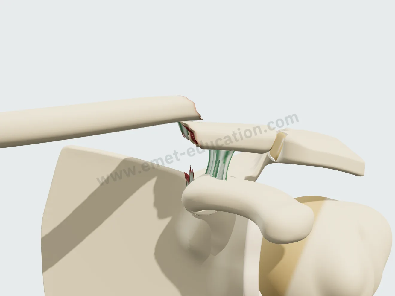 Fracture du bout de la clavicule entre les ligaments : le fragment interne remonte.