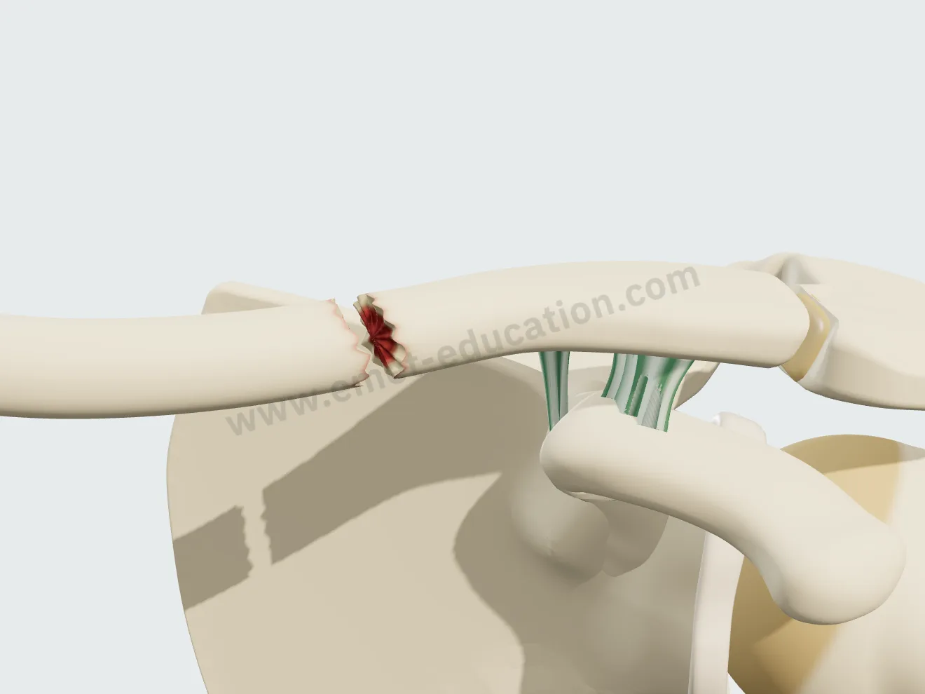 Début de pseudarthrose : les bords de la fracture se résorbent, un espace se creuse.