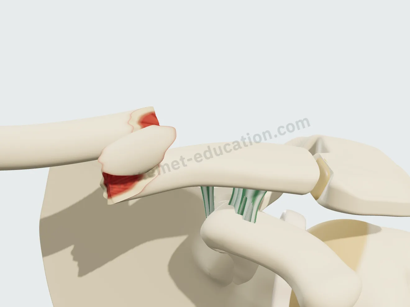 Traitement orthopédique, point de départ : fracture de la diaphyse avec un troisième fragment, déplacée et raccourcie.