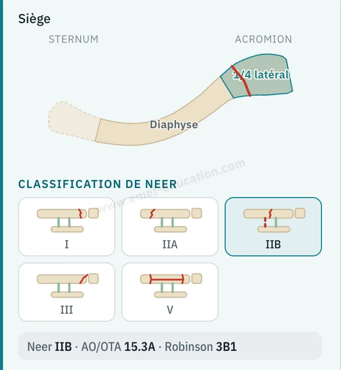 Panneau du modèle de la clavicule : schéma du siège, quart latéral choisi, pictogrammes de la classification de Neer, IIB sélectionné.