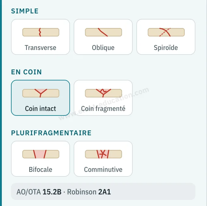 Panneau du modèle : sept pictogrammes de trait (transverse, oblique, spiroïde, coin intact, coin fragmenté, bifocale, comminutive), coin intact choisi, classification AO/OTA 15.2B, Robinson 2A1.
