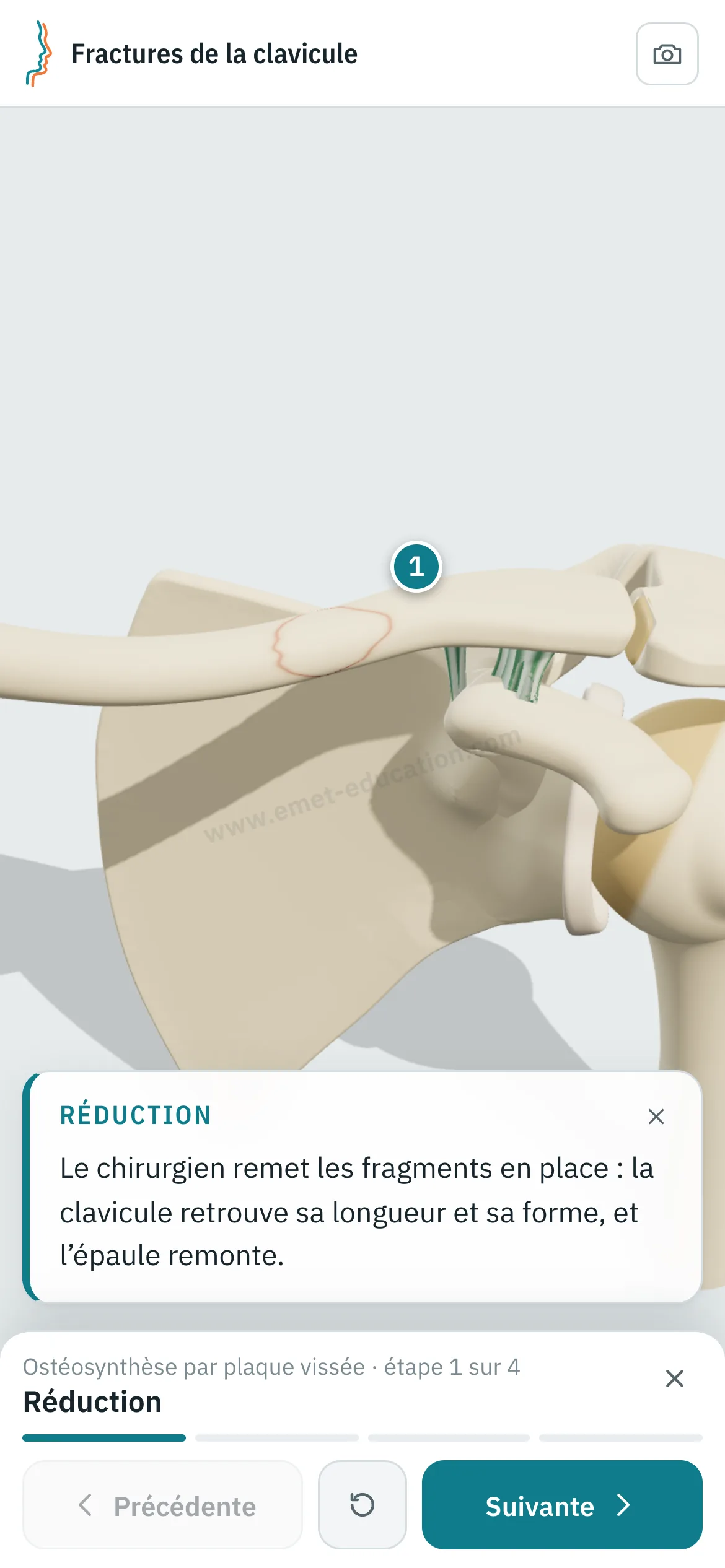 Vue patient sur un téléphone : l'ostéosynthèse par plaque vissée rejouée, étape 1 sur 4, Réduction.