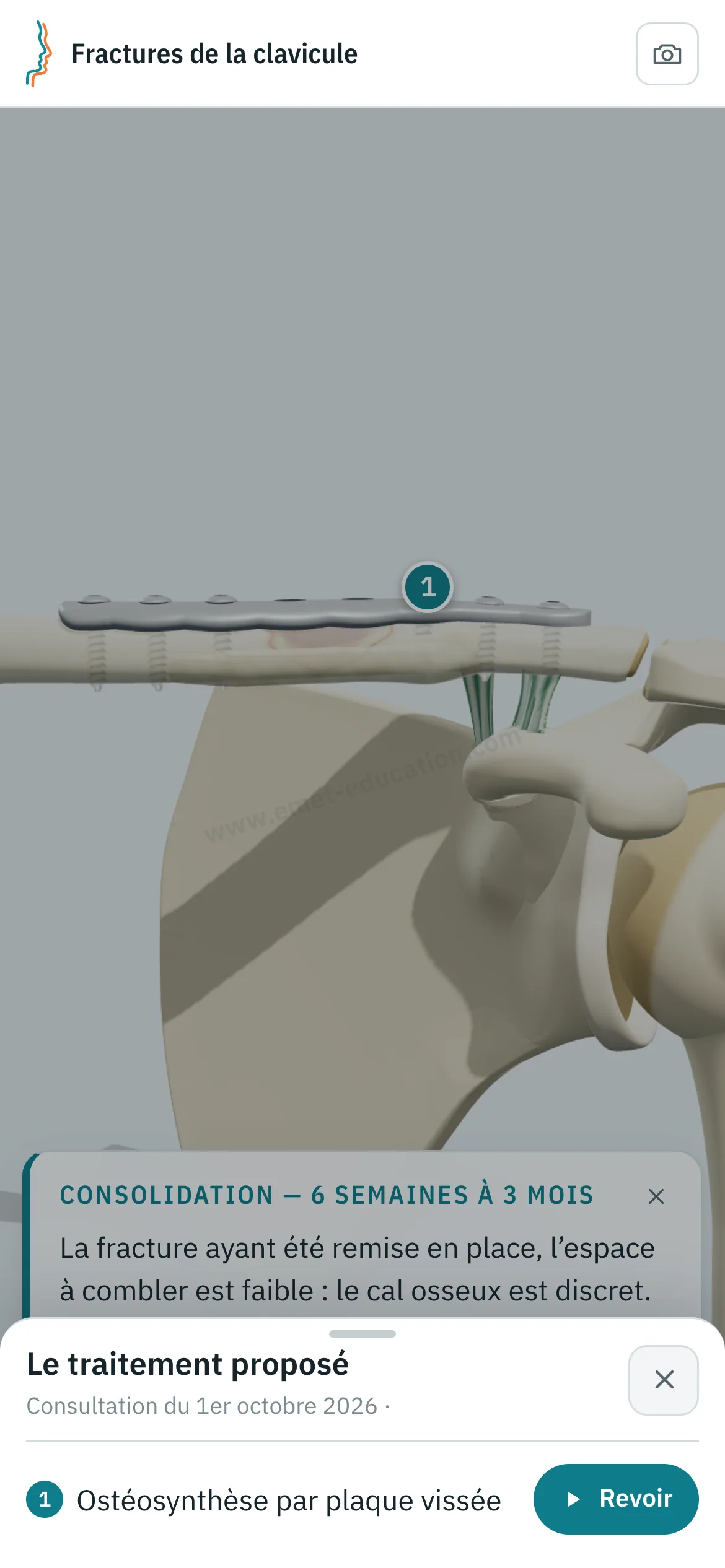 Vue patient sur un téléphone : la clavicule après ostéosynthèse par plaque vissée, et le volet « Le traitement proposé » avec le bouton « Revoir ».