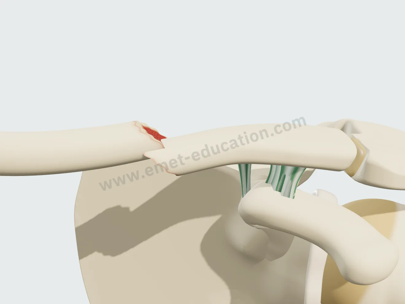 Fracture simple de la clavicule : un trait oblique sépare deux fragments.