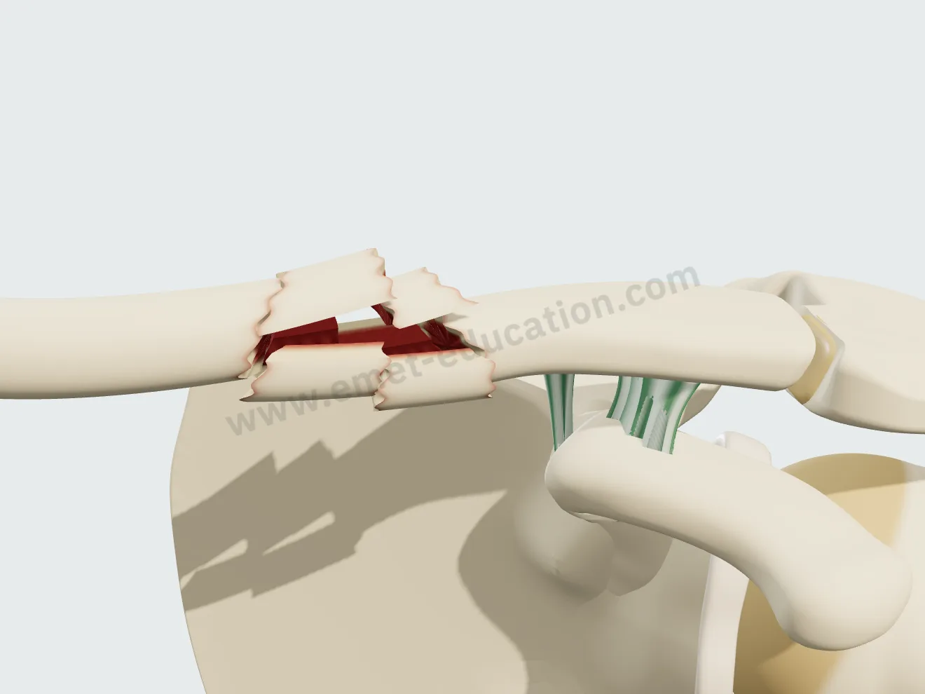 Fracture comminutive de la clavicule : l'os a éclaté en plusieurs fragments.