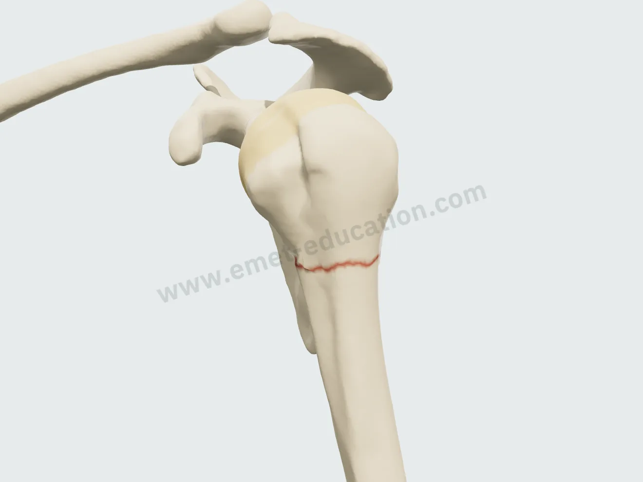 Clou centromédullaire, étape 1 : la fracture du col chirurgical réduite.