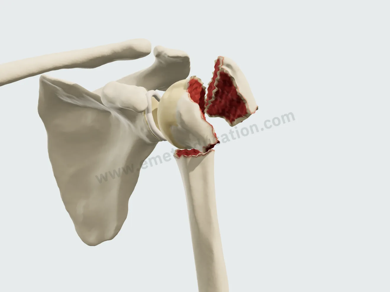 Fracture à 3 parties : col chirurgical et tubercule majeur, tiré en haut et en arrière, tête en varus.