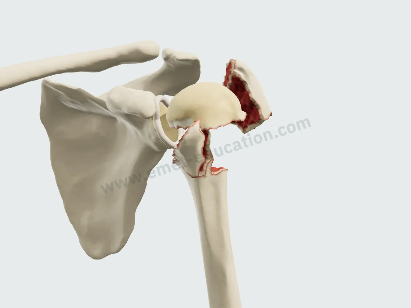 Fracture à 4 parties : tête en valgus, tubercules majeur et mineur séparés, diaphyse translatée.