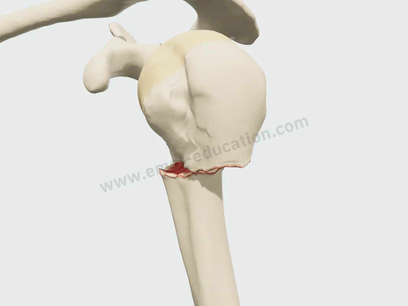 Pseudarthrose du col chirurgical, premier temps : berges érodées, un espace creusé entre la tête et la diaphyse.