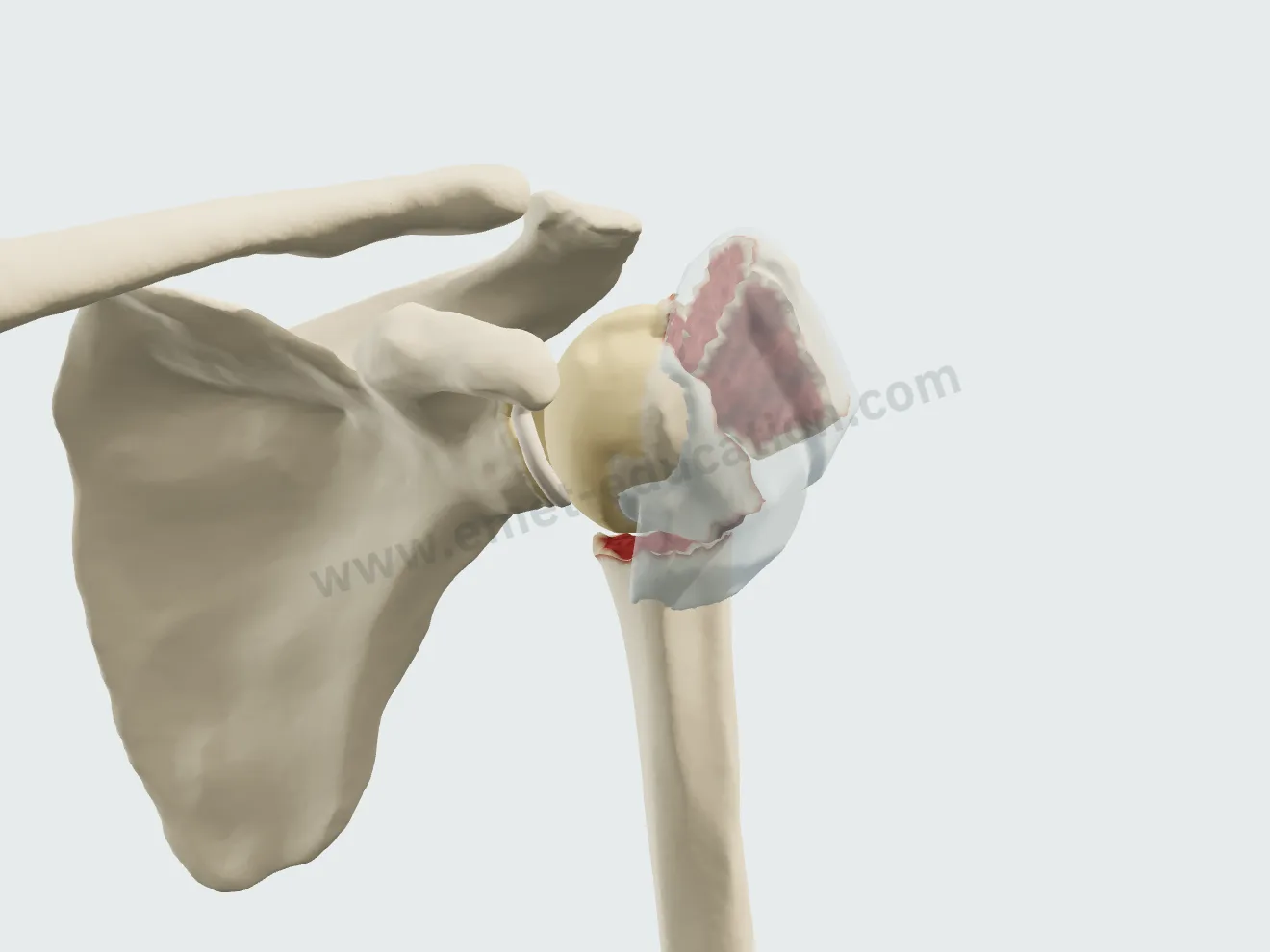Traitement orthopédique, étape 2 : le cal mou, tissu translucide entre les fragments.