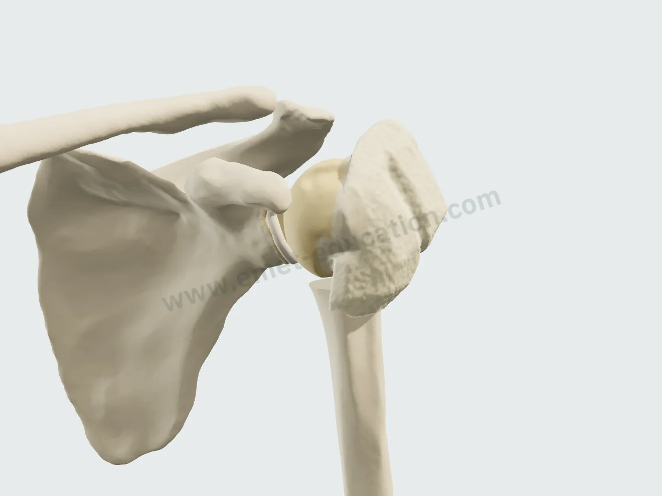 Traitement orthopédique, étape 3 : le cal osseux, minéralisé, soude les fragments.