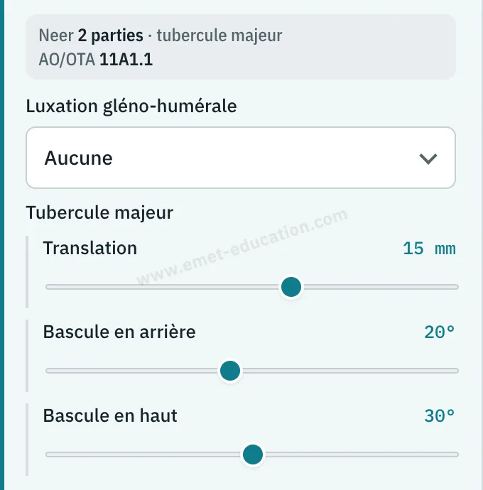 Panneau du modèle : classification lue en direct (Neer 2 parties · tubercule majeur, AO/OTA 11A1.1), jauges du tubercule majeur : translation de 15 mm, bascules de 20° en arrière et de 30° en haut.