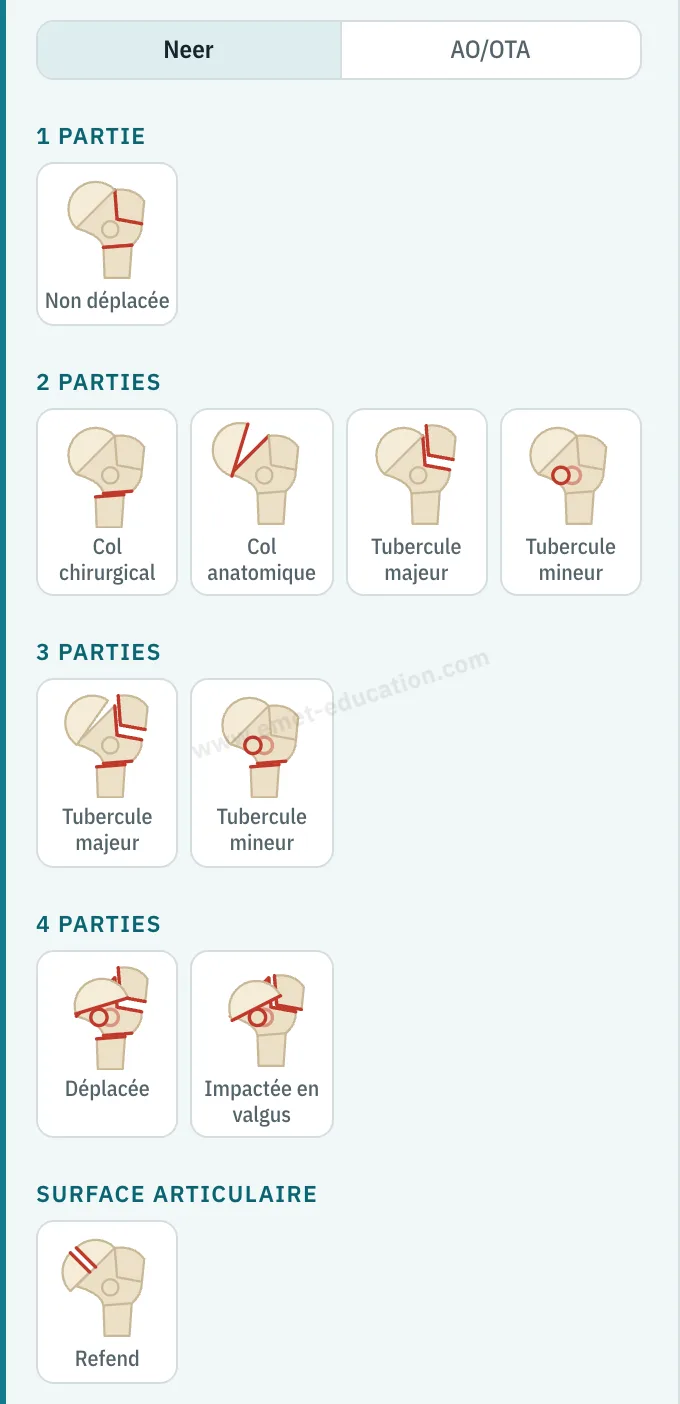 Panneau du modèle : sélecteur Neer · AO/OTA, dix pictogrammes de Neer groupés de 1 à 4 parties, et la surface articulaire.