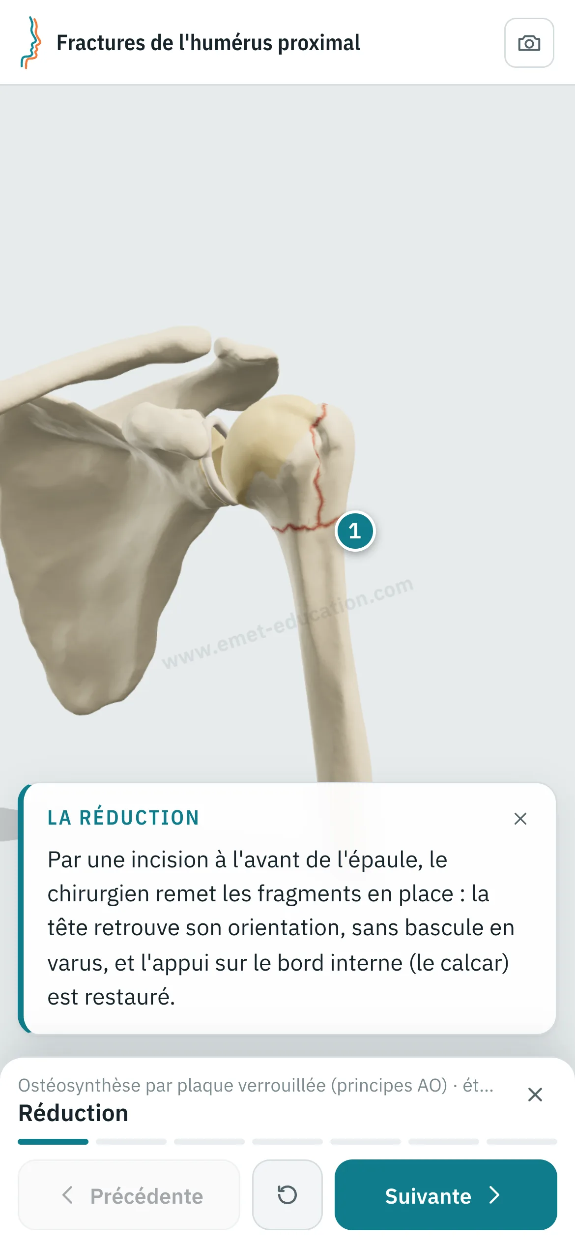 Vue patient sur un téléphone : l'ostéosynthèse par plaque verrouillée rejouée étape par étape.