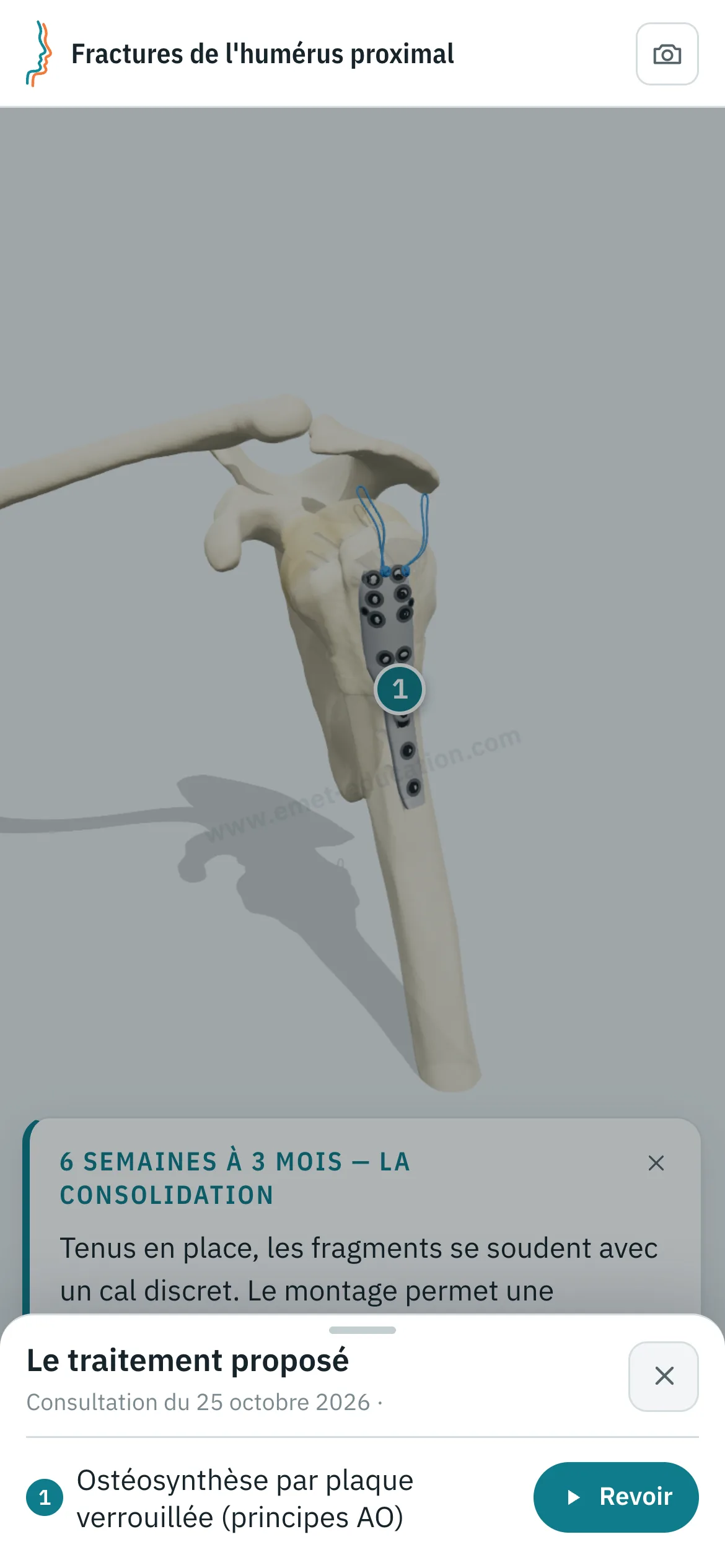 Vue patient sur un téléphone : l'humérus après plaque verrouillée, et le volet « Le traitement proposé » ouvert, avec le bouton « Revoir ».