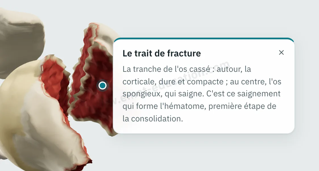 Bulle d'explication « Le trait de fracture » affichée après un toucher sur la tranche du tubercule majeur : la corticale, l'os spongieux qui saigne, l'hématome.