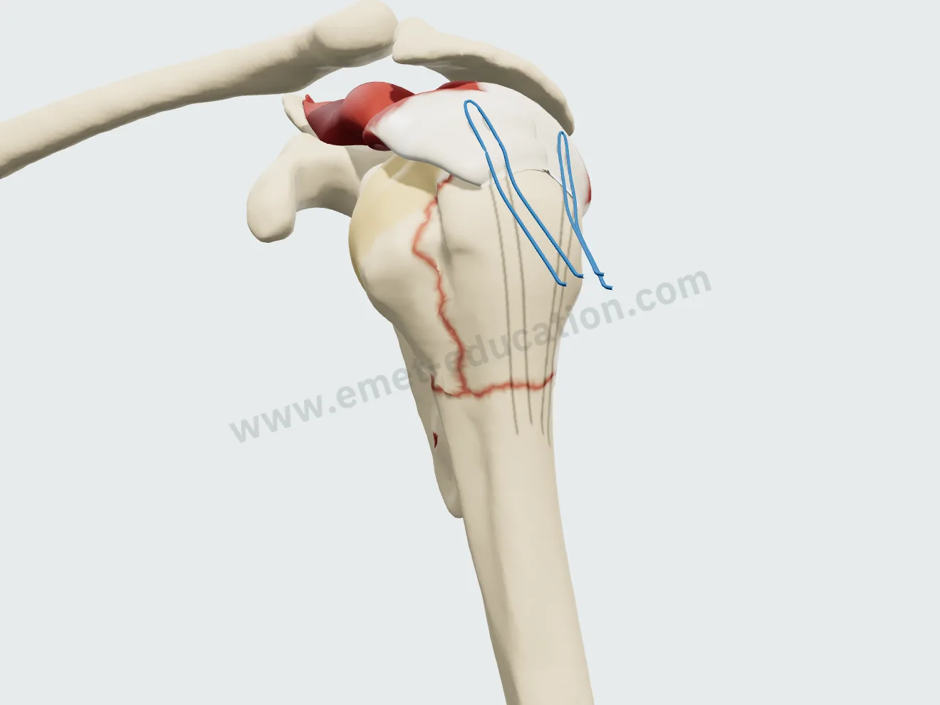 Plaque verrouillée, étape 2 : sutures passées dans les tendons supra- et infra-épineux.
