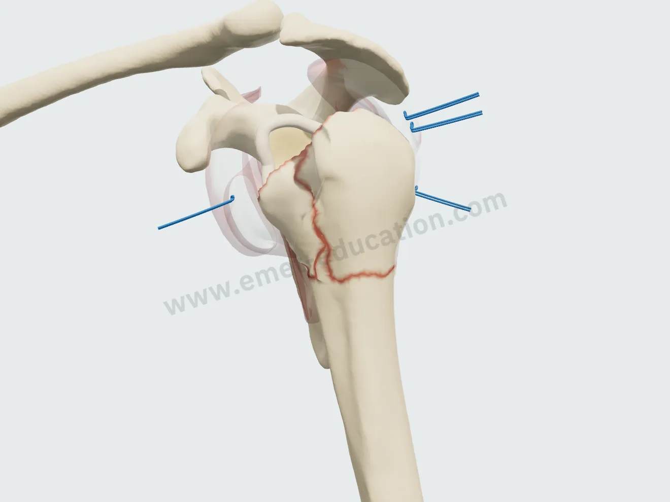 Prothèse inversée, étape 2 : fils passés à la jonction tendon-os des tubercules.