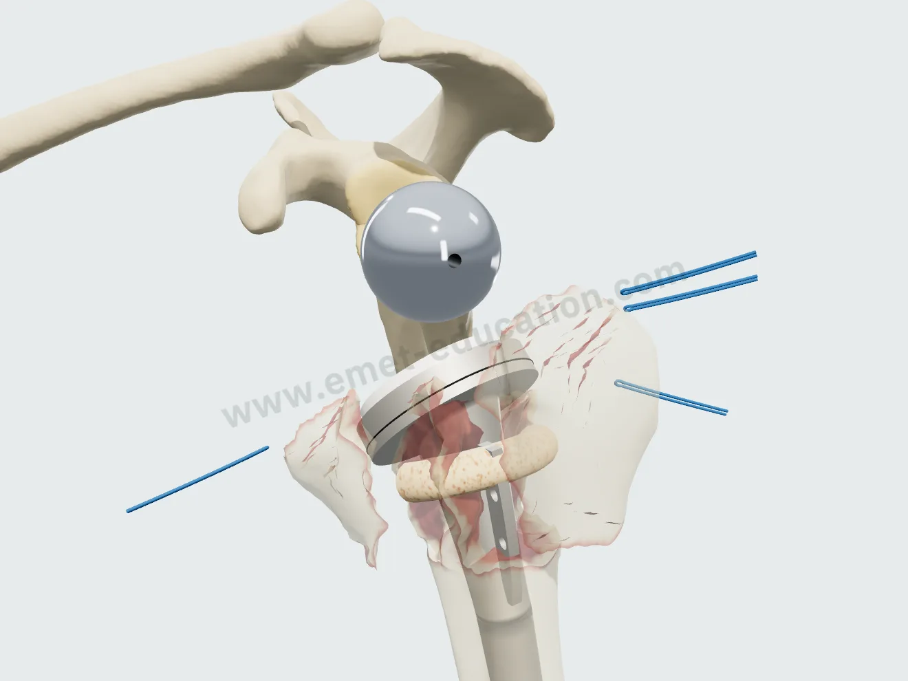 Prothèse inversée, étape 4 : tige de fracture, greffon spongieux autour de la métaphyse, insert.