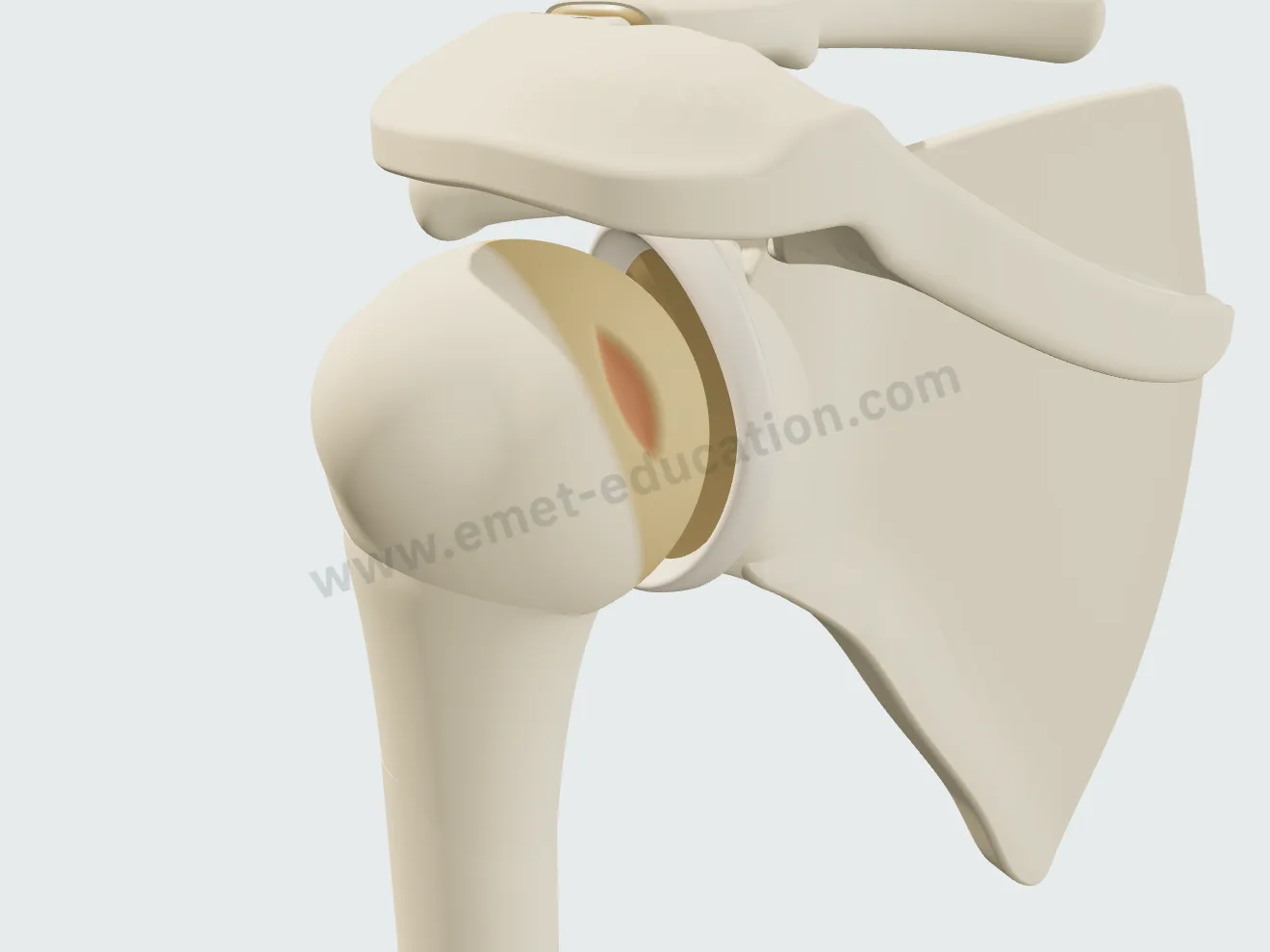 Vue postérieure de la tête humérale : petite encoche de Hill-Sachs au bord du cartilage.