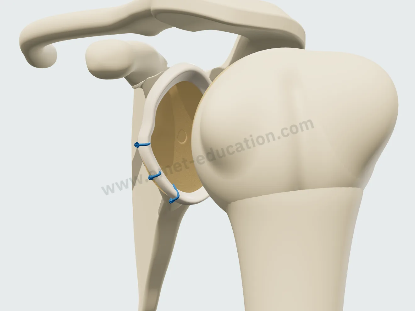 Réparation du labrum, étape 3 : nœuds serrés, le labrum réappliqué contre le rebord de la glène.