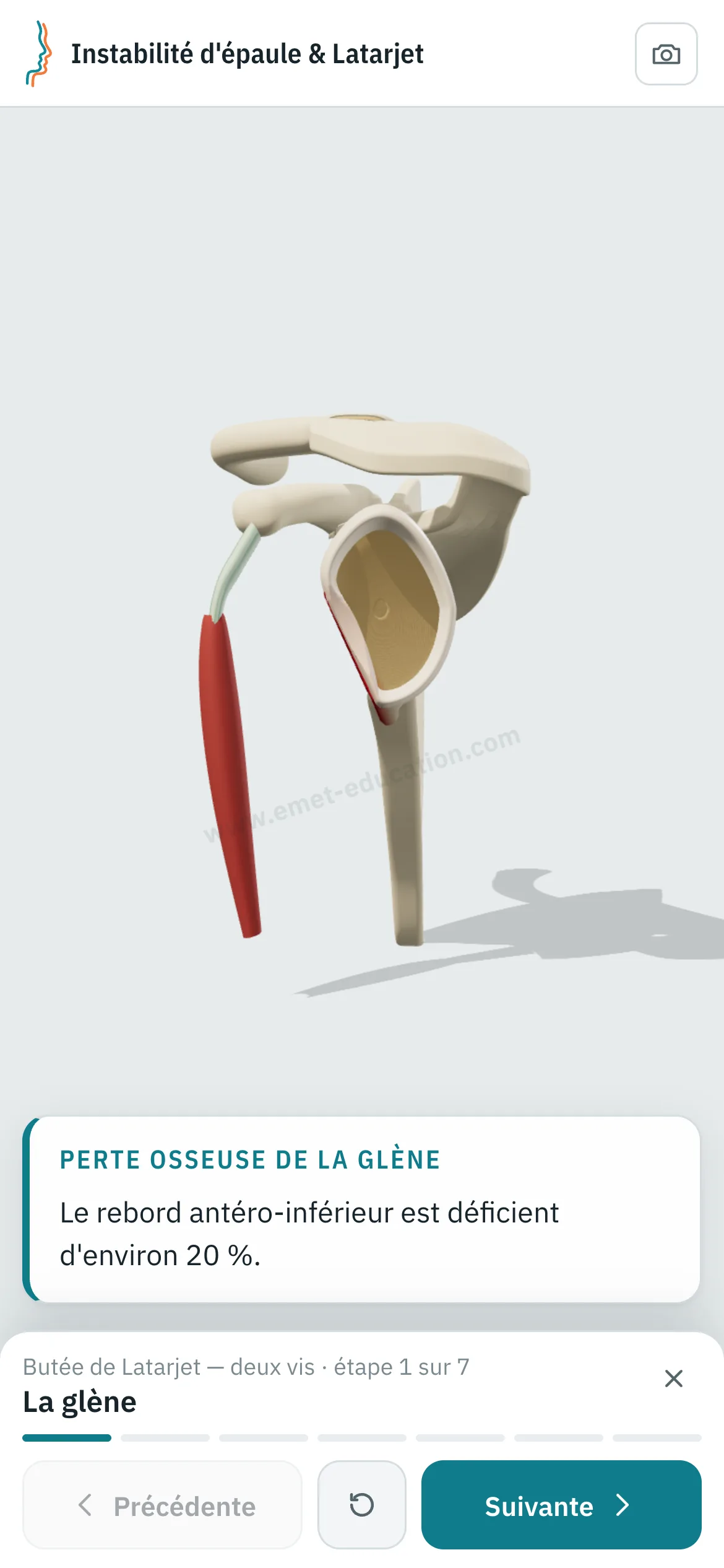 Vue patient sur un téléphone : la butée de Latarjet rejouée étape par étape.