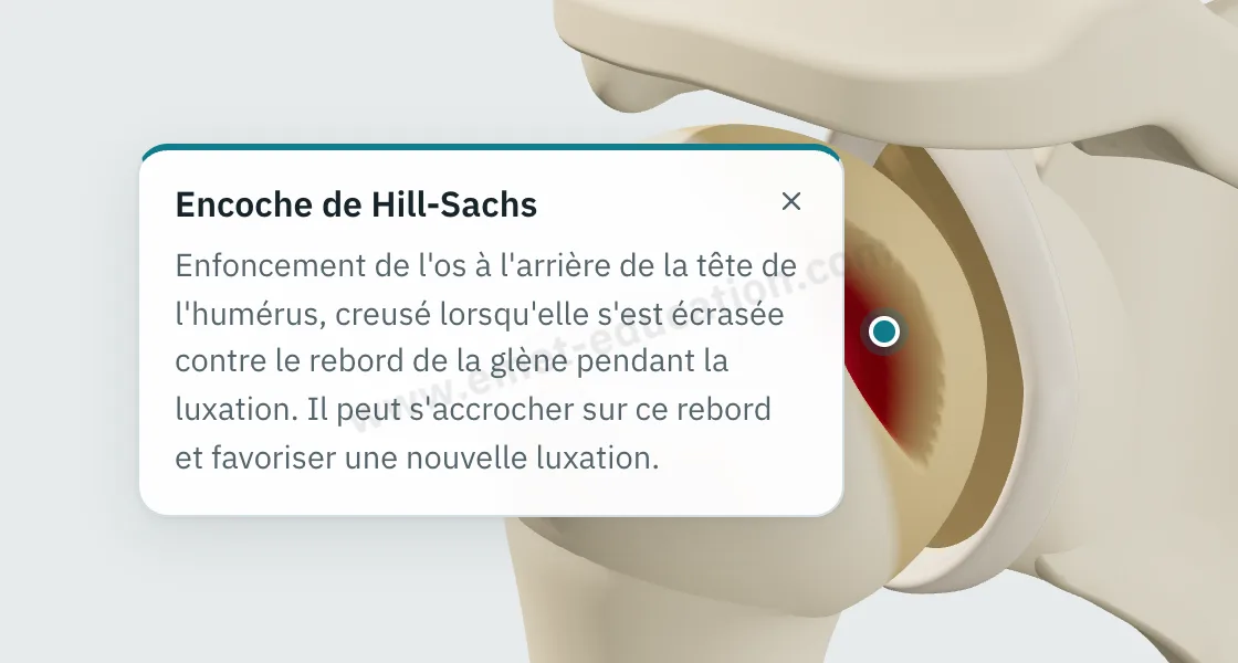 Bulle d'explication « Encoche de Hill-Sachs » affichée après un toucher sur l'encoche, à l'arrière de la tête humérale.