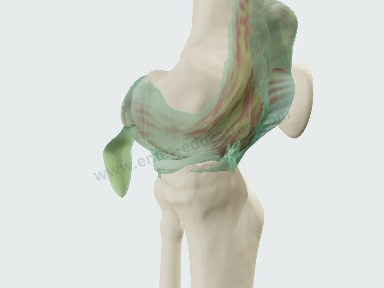 Épanchement abondant : patella décollée, kyste poplité en arrière du genou.