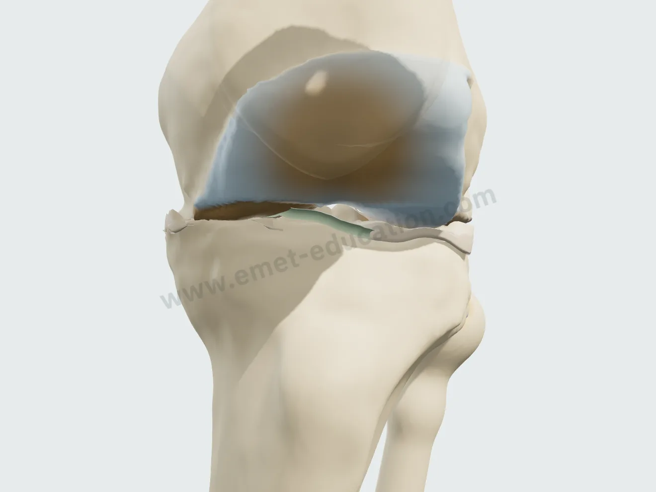 Genou de face, grade IV : os contre os, tassement du plateau et du condyle, volumineux ostéophytes.