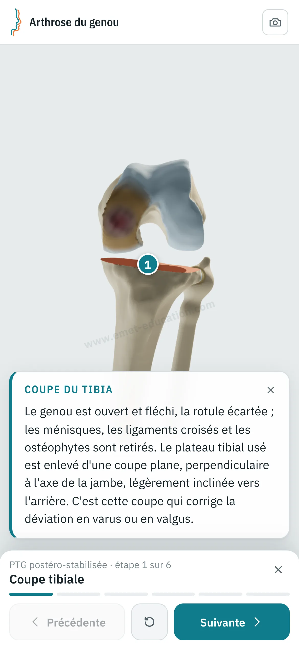 Vue patient sur un téléphone : la prothèse totale rejouée étape par étape.