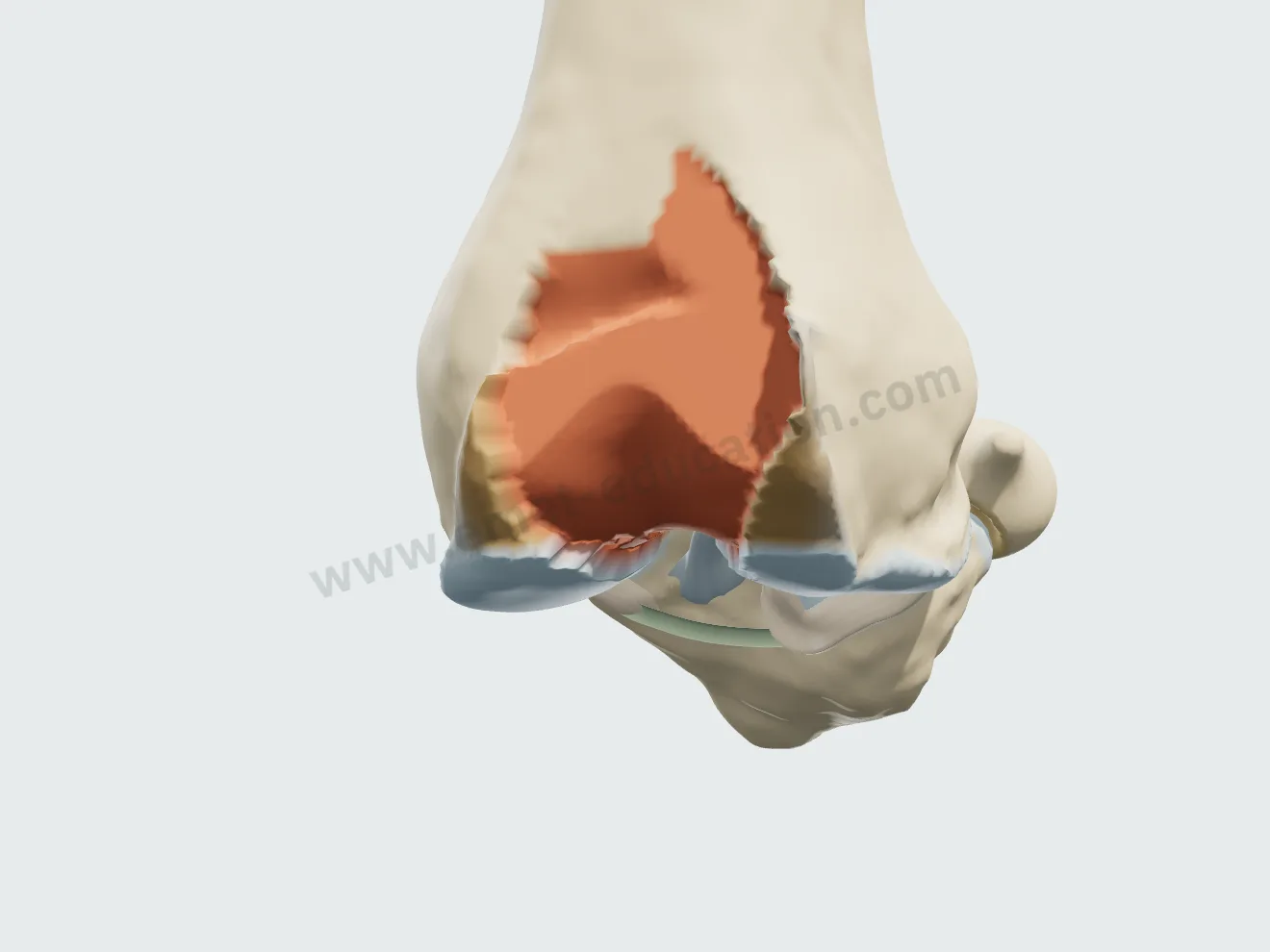 Prothèse fémoro-patellaire, étape 1 : trochlée fraisée, genou fléchi.