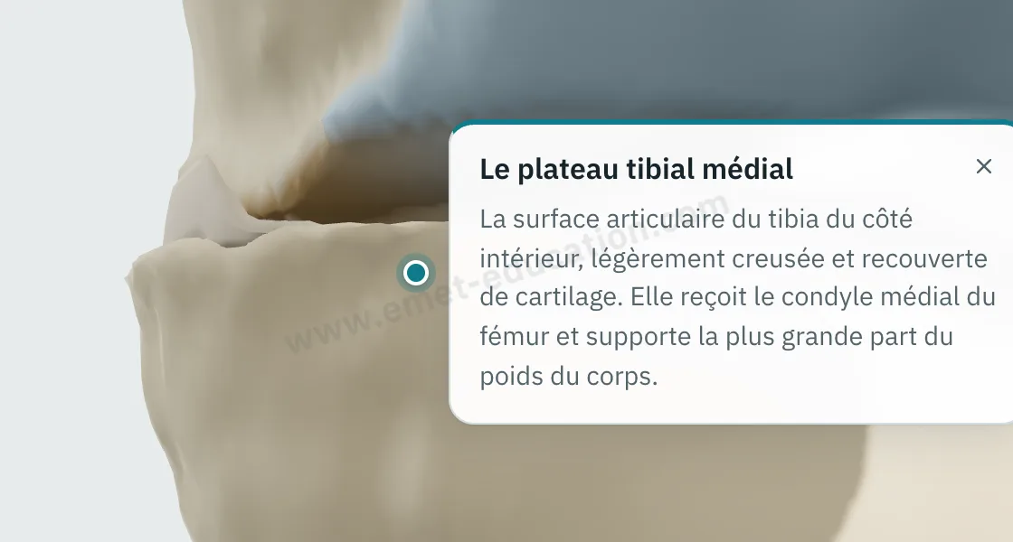 Bulle d'explication affichée après un toucher sur un ostéophyte du condyle fémoral interne.