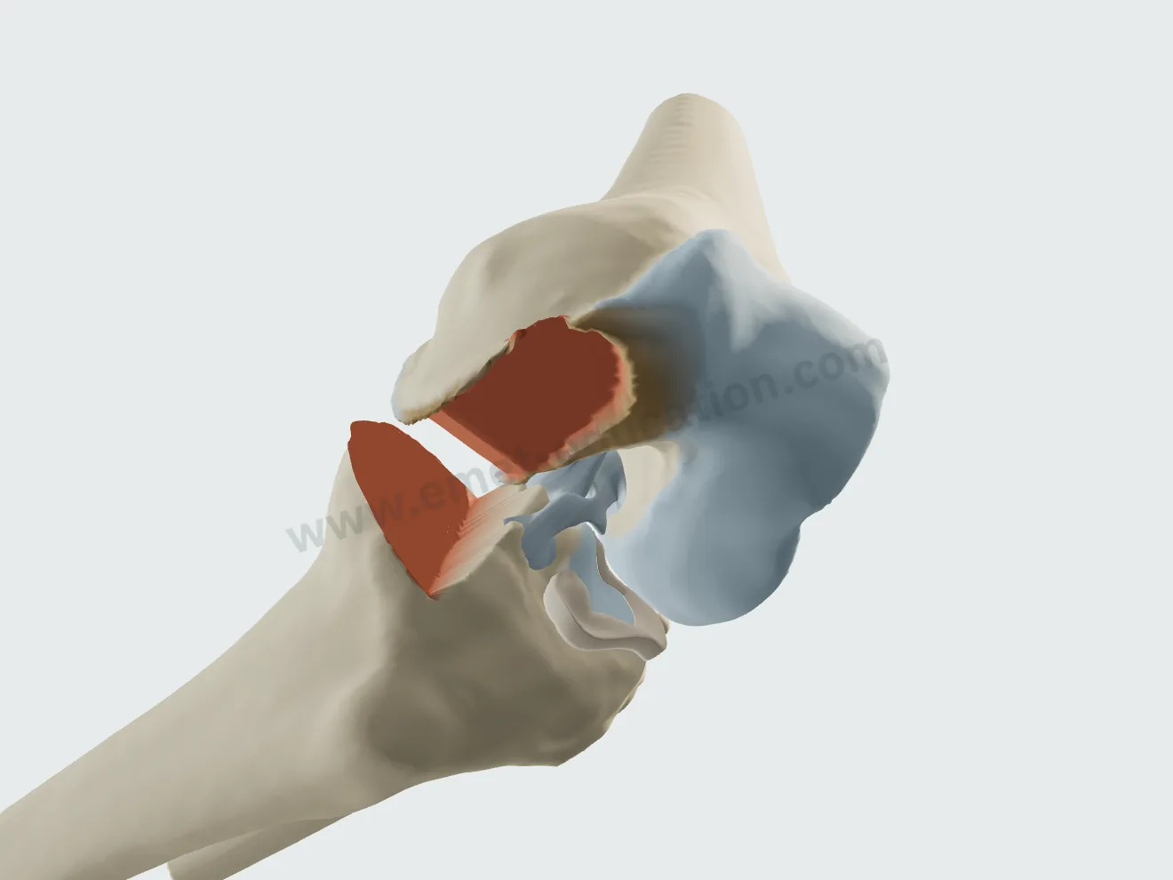 Prothèse unicompartimentale, étape 2 : le seul condyle recoupé.