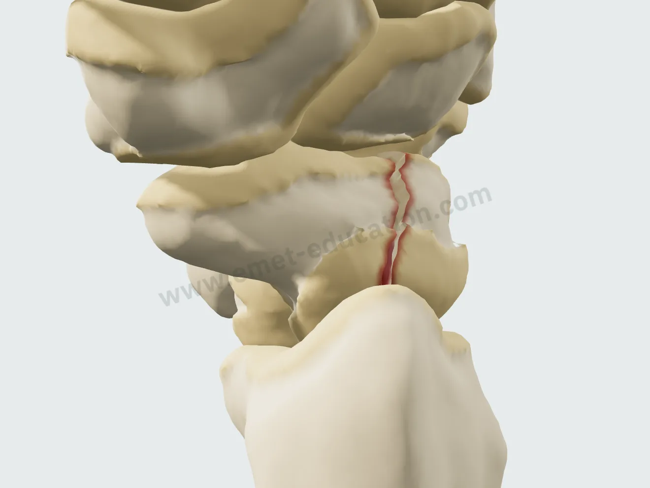 Fracture de la taille déplacée d'au moins 1 mm : les fragments décalés.