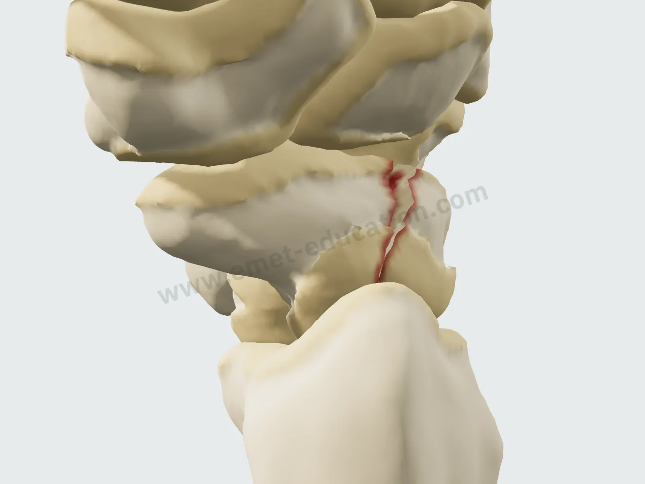 Fracture de la taille avec bascule : fragment proximal et lunatum en extension (DISI).