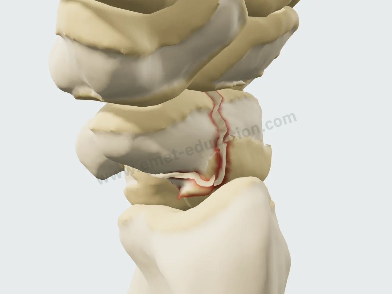 Fracture comminutive de la taille : éclat palmaire détaché entre les deux fragments.