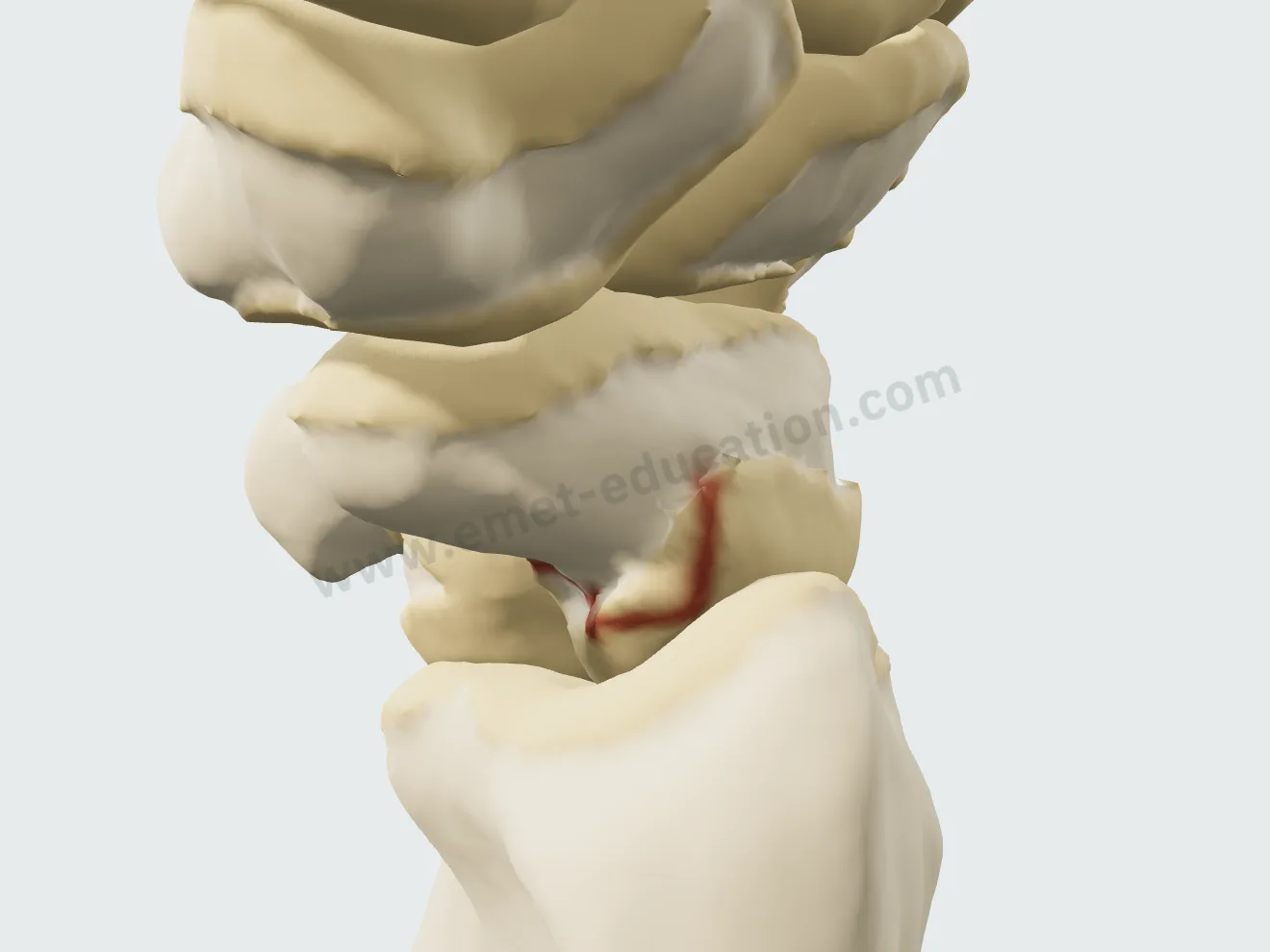Fracture incomplète de la taille : une fissure sur les faces palmaire et radiale.