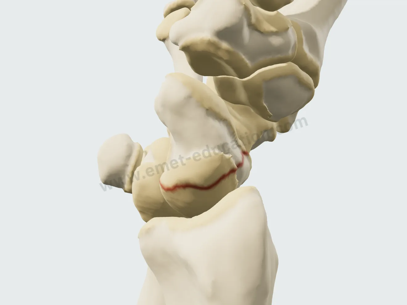 Réduction ouverte, étape 1 : le fragment proximal et le lunatum redressés.