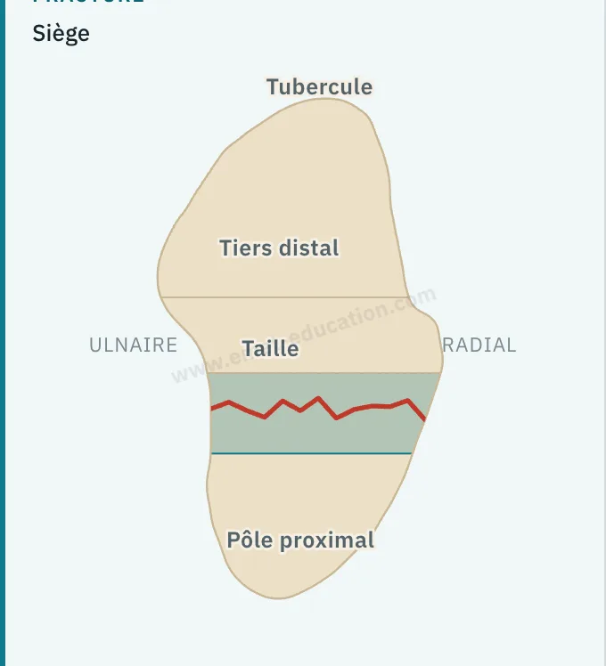 Panneau du modèle : schéma cliquable du scaphoïde, siège sur la taille, classification Herbert B2 et Schernberg II.