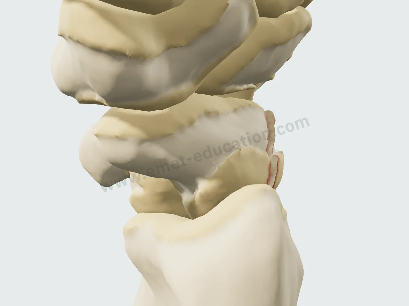 Fracture du pôle proximal du scaphoïde, le trait près du radius.