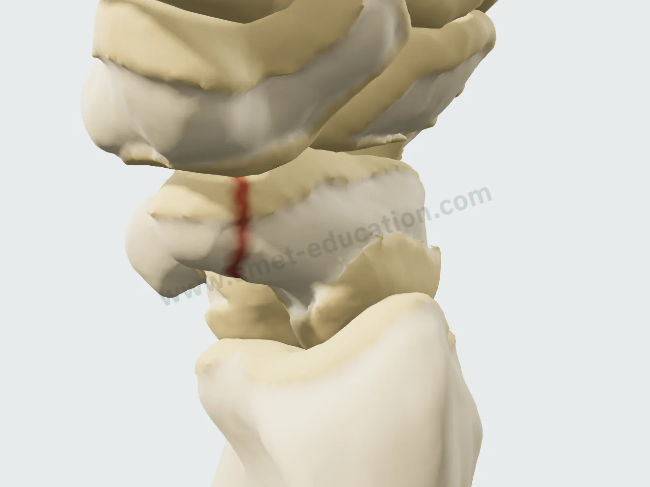 Fracture du tubercule du scaphoïde : un petit fragment palmaire détaché (Herbert A1).