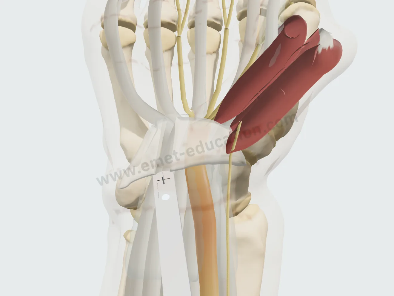 Libération endoscopique, étape 2 : la lame sectionne le ligament en se retirant, sous contrôle de la caméra.