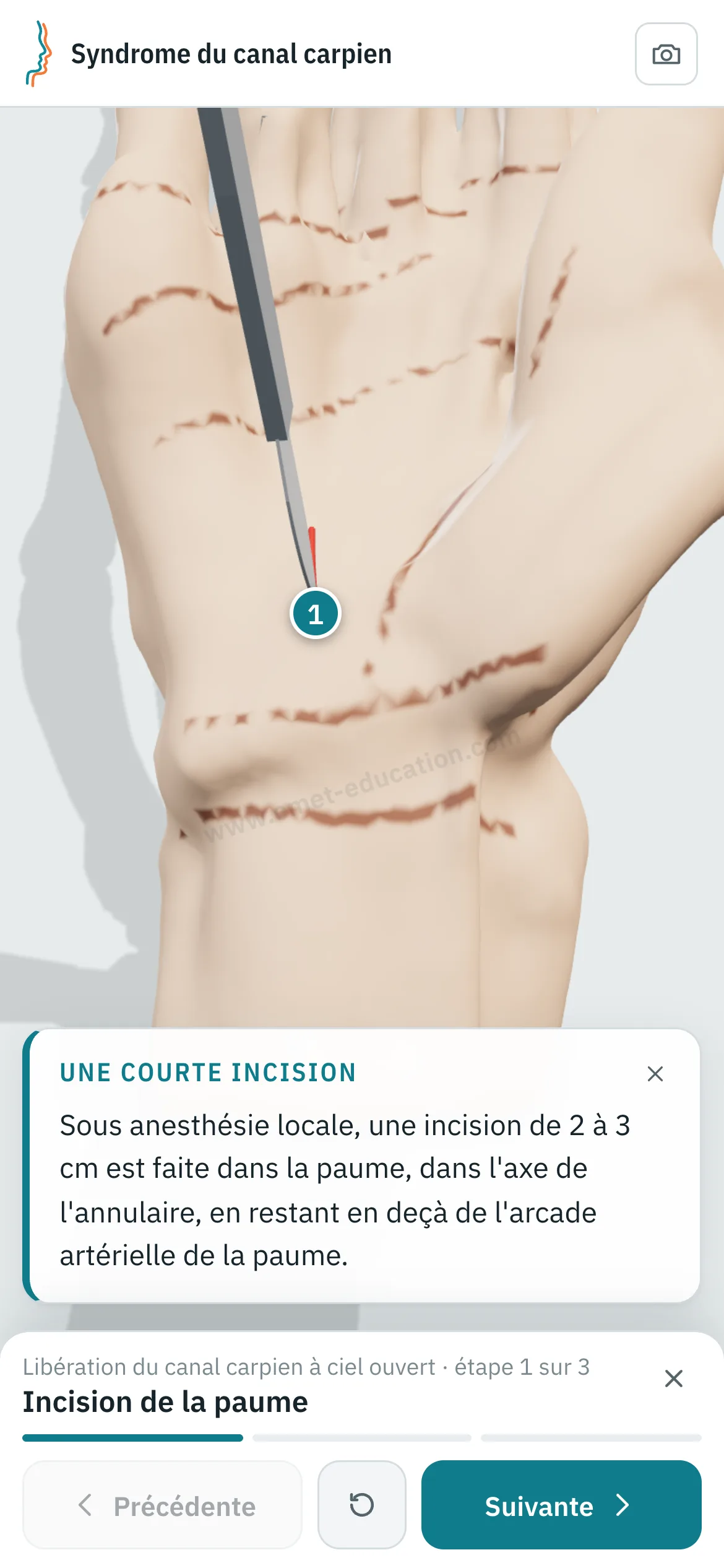 Vue patient sur un téléphone : la libération du canal carpien rejouée étape par étape.
