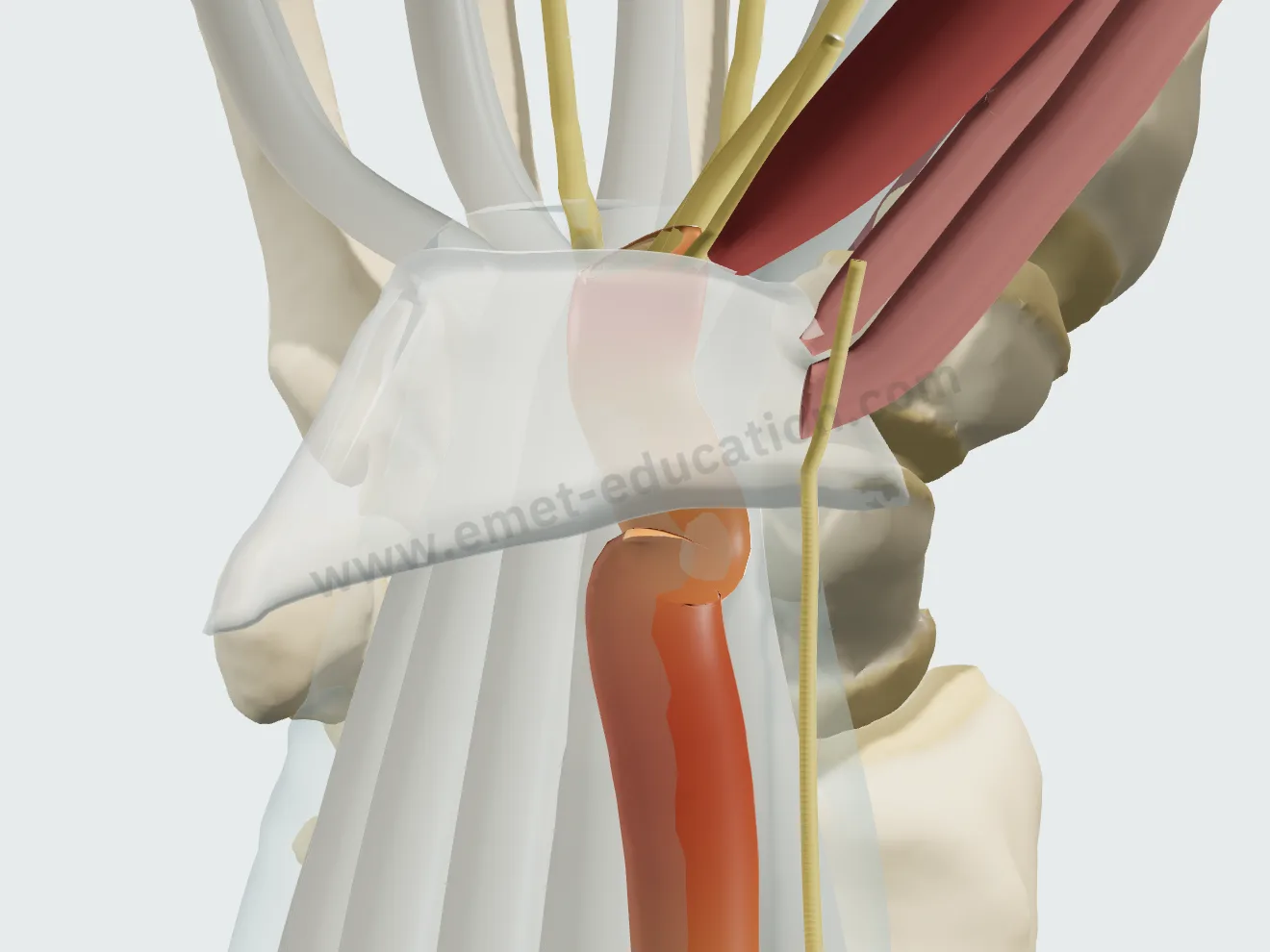 Sévérité sévère : nerf très aplati, muscles thénariens amyotrophiés.