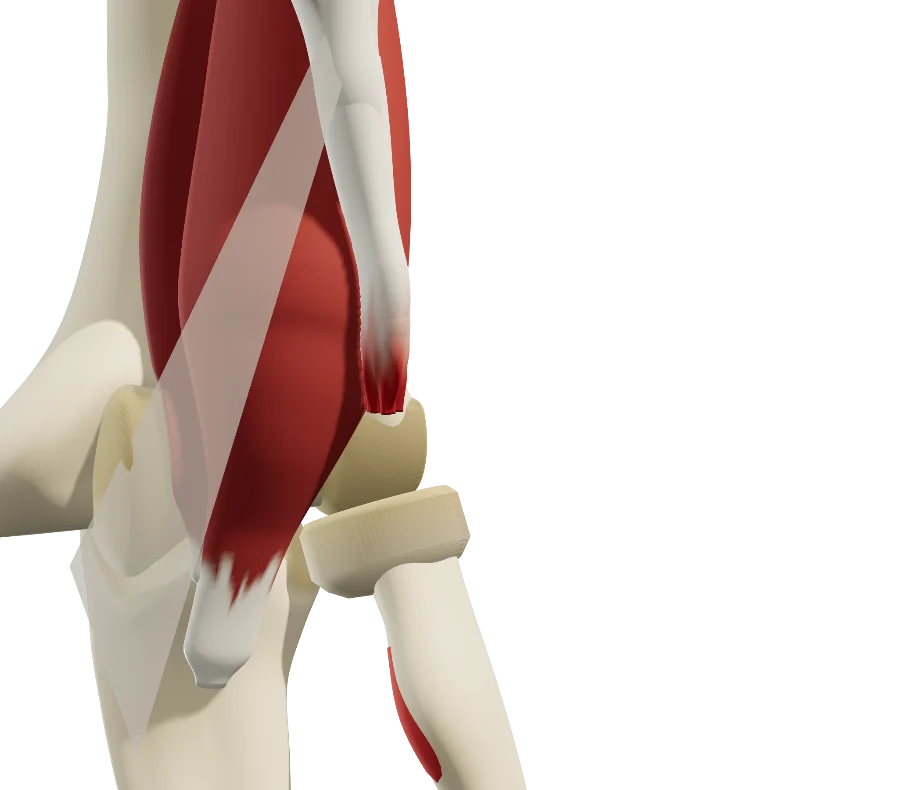 Coude en 3D vu de face : le tendon distal du biceps rompu, son bout effiloché remonté au-dessus de la tubérosité radiale mise à nu.
