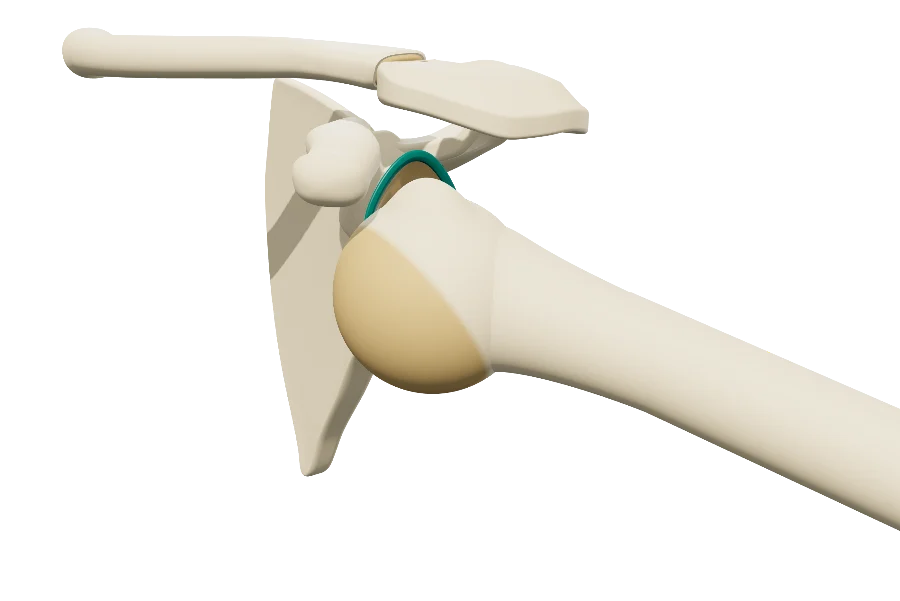 Dislocated shoulder in 3D: the humeral head out of the glenoid, arm in abduction and external rotation.